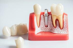 dental implantar, artificial dente raízes para dentro mandíbula, raiz canal do dental tratamento, Chiclete doença, dentes modelo para dentista estudando sobre odontologia. foto