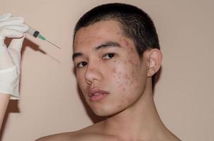 as cicatrizes e rugas causadas pela acne na pele por hormônio ou sujeira. foto