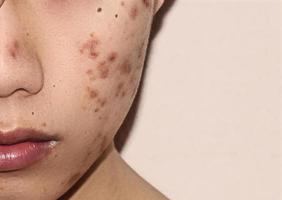close up de acne na pele, acne no rosto causada por hormônio. foto