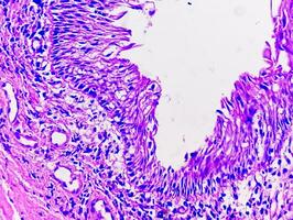 histologia do urachal cisto. fotomicrografia do histológico manchado deslizar mostrando urachal cisto. uretral cisto. foto