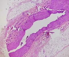 fotomicrografia, pré-patelar região histologia mostrando bursite, agudo ou crônica bursite. foto