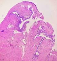 histologia do urachal cisto. fotomicrografia do histológico manchado deslizar mostrando urachal cisto. uretral cisto. foto