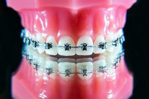 a suspensórios estão em a dentes dentro a artificial mandíbula em uma Preto fundo. macro fotografia foto