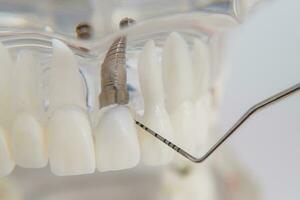 uma modelo do dentes com implantes mentiras em uma mesa foto