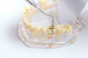 médico ortodontista mostra a instrumento em cárie dentro a dentes foto