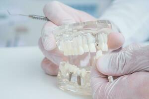 a ortodontista detém uma modelo do dentes com implantes dentro dele mão e mostra quão para inserir a dente. fechar acima. macro foto