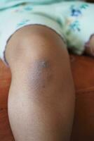 mancha ematoma ferida em criança joelho. foto