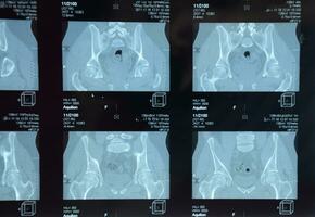 mri sacroilíaco articulação. estude do anquilosante espondiloartrite paciente. foto