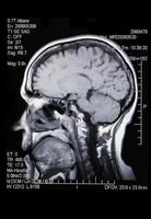 uma verdadeira ressonância magnética da vasculatura cerebral foto