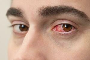 fechar acima do forte injetado de sangue vermelho sangue olho do masculino afetado de conjuntivite ou depois de alergia. homem com viral blefarite, conjuntivite, adenovírus. foto