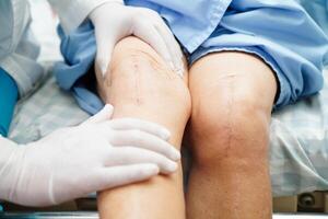 médico verificando paciente idosa asiática com cirurgia de substituição do joelho de cicatriz no hospital. foto