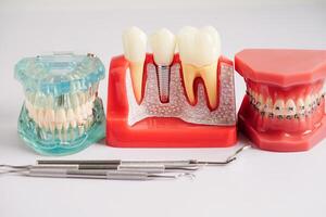 dental implantar, artificial dente raízes para dentro mandíbula, raiz canal do dental tratamento, Chiclete doença, dentes modelo para dentista estudando sobre odontologia. foto