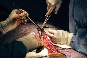 fechar acima do cirurgiões mãos com bisturi às Operação dentro operativo quarto às hospital foto