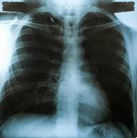 imagem de raio-x, vista dos homens no peito para diagnóstico médico. foto