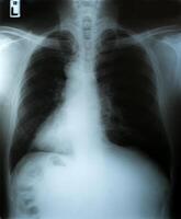 imagem de raio-x, vista dos homens no peito para diagnóstico médico. foto