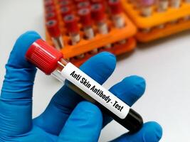 cientista mão segurando sangue amostra para anti pele anticorpo teste. foto