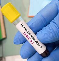 sangue amostra para hhv 6 ou humano herpesvírus 6 e hhv 8 teste, roséola foto