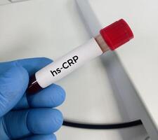 sangue amostra para hscrp ou Alto sensibilidade crp teste, para a diagnóstico do inflamatório coração doença. foto