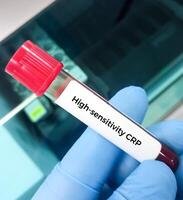 sangue amostra para hscrp ou Alto sensibilidade crp teste, para a diagnóstico do inflamatório coração doença. foto