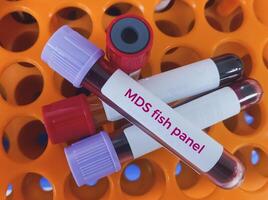 sangue amostra para mielodisplásica síndrome teste. para diagnosticar mds, uma cheio sangue contagem e uma osso medula biópsia. foto