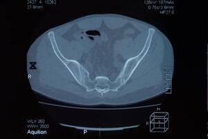 mri sacroilíaco articulação. estude do anquilosante espondiloartrite paciente. foto