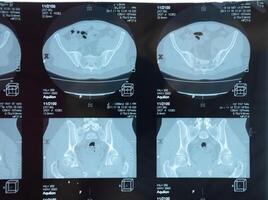 mri sacroilíaco articulação. estude do anquilosante espondiloartrite paciente. foto