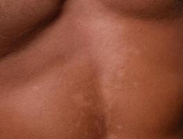 queimadura de sol em a pele do a estômago. esfoliação, pele cascas desligado. perigoso Sol bronzeado foto