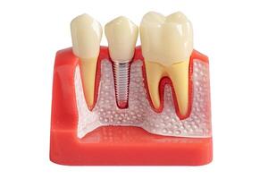 dental implantar, artificial dente raízes para dentro mandíbula, raiz canal do dental tratamento, Chiclete doença, dentes modelo para dentista estudando sobre odontologia. foto