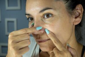 retrato do uma mulher refletido dentro uma espelho com uma pequeno espinha em dela face, ela mostra isto com dela dedos. pele com acne. pele este necessidades acne tratamento. foto