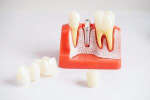 dental implantar, artificial dente raízes para dentro mandíbula, raiz canal do dental tratamento, Chiclete doença, dentes modelo para dentista estudando sobre odontologia. foto