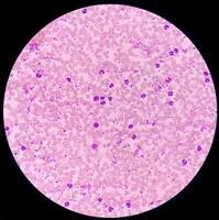 essencial trombocitose sangue mancha mostrando anormal Alto volume do plaquetas e branco sangue células. panmielose. mieloprociferativo transtorno. foto