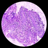 íleo-cecal úlcera. crônica inespecífico ileíte com úlcera. seção mostrar ileal mucosa, denso infiltração do linfócitos, histiócitos, plasma célula dentro lâmina própria. ibid. foto