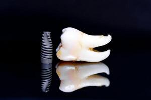 dente modelo e implantar em Preto fundo. arte foto para dental conceito.