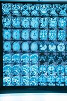 raio X imagem do a cérebro computado tomografia. neurocirurgia conceito. foto