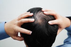 Careca cabeça dentro homem, cabelo perda tratamento saúde problema. foto