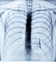 imagem de raio-x do peito humano foto