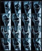 magnético ressonância tomografia senhor imagens do joelho foto