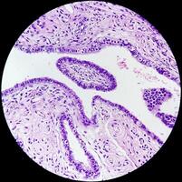 histopatológico fotomicrografia do ovário cisto mostrando metastático cístico teratoma. foto