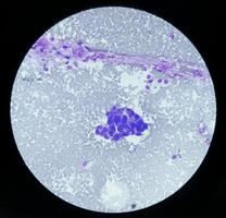 ascético fluido citologia, maligno células, metastático adenocarcinoma foto