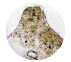 esquistossomose parasita óvulos dentro humano urina espécime debaixo microscópio. urinário parasita foto