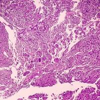 histologia, peritoneal inclusão cisto. paraovariano cistos, hidrossalpinge e nota baixa cístico mesotelioma estão geralmente considerado dentro a diferencial diagnóstico do fotos. foto