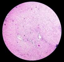 histologia, peritoneal inclusão cisto. paraovariano cistos, hidrossalpinge e nota baixa cístico mesotelioma estão geralmente considerado dentro a diferencial diagnóstico do fotos. foto