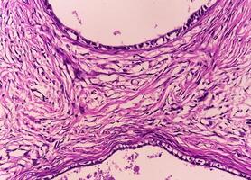 histologia, peritoneal inclusão cisto. paraovariano cistos, hidrossalpinge e nota baixa cístico mesotelioma estão geralmente considerado dentro a diferencial diagnóstico do fotos. foto