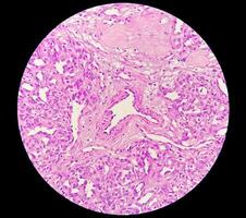 histologia, peritoneal inclusão cisto. paraovariano cistos, hidrossalpinge e nota baixa cístico mesotelioma estão geralmente considerado dentro a diferencial diagnóstico do fotos. foto