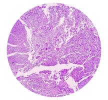 histologia, peritoneal inclusão cisto. paraovariano cistos, hidrossalpinge e nota baixa cístico mesotelioma estão geralmente considerado dentro a diferencial diagnóstico do fotos. foto