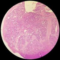 histologia, peritoneal inclusão cisto. paraovariano cistos, hidrossalpinge e nota baixa cístico mesotelioma estão geralmente considerado dentro a diferencial diagnóstico do fotos. foto