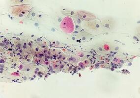 fotomicrografia do paparazzi manchar. inflamatório mancha com vaginal candidíase . médico conceito foto