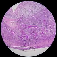 histologia, peritoneal inclusão cisto. paraovariano cistos, hidrossalpinge e nota baixa cístico mesotelioma estão geralmente considerado dentro a diferencial diagnóstico do fotos. foto