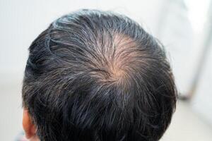 careca na cabeça do meio e começar sem perda de cabelo glabro de homem de escritório ativo inteligente de negócios asiáticos maduros. foto