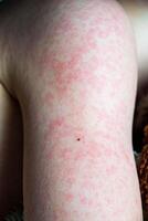 viral doença. sarampo erupção cutânea em a corpo do a criança. alergia foto